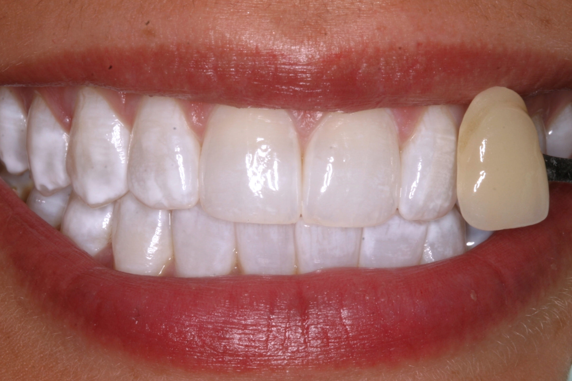 Seeing Is Believing Amazing Kr Whitening Results intended for Teeth Whitening Bleach