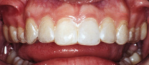 KoR-Seal Tray Upper_on teeth