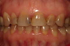 Before