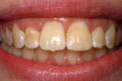 Before