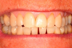 Before