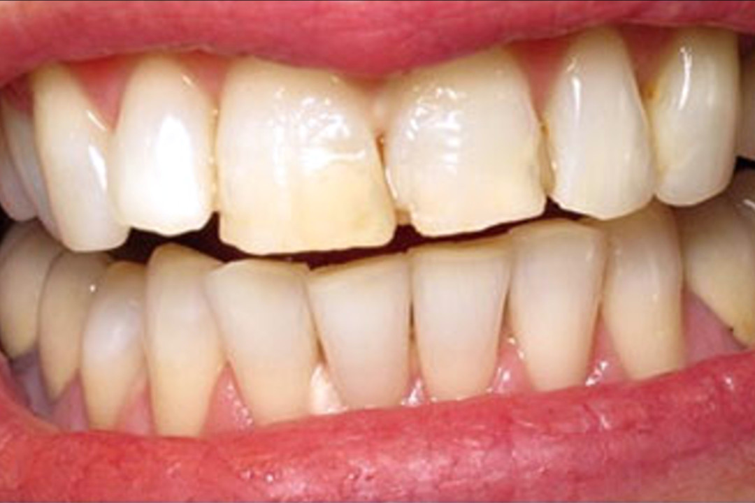 340AFTER + • KöR Whitening
