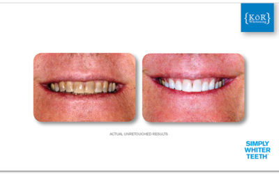 See How KöR Whitening is Helping Patients with Tetracycline Stains