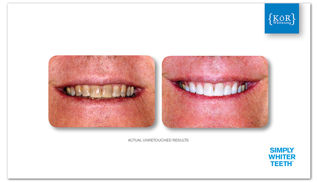 See How KöR Whitening is Helping Patients with Tetracycline Stains