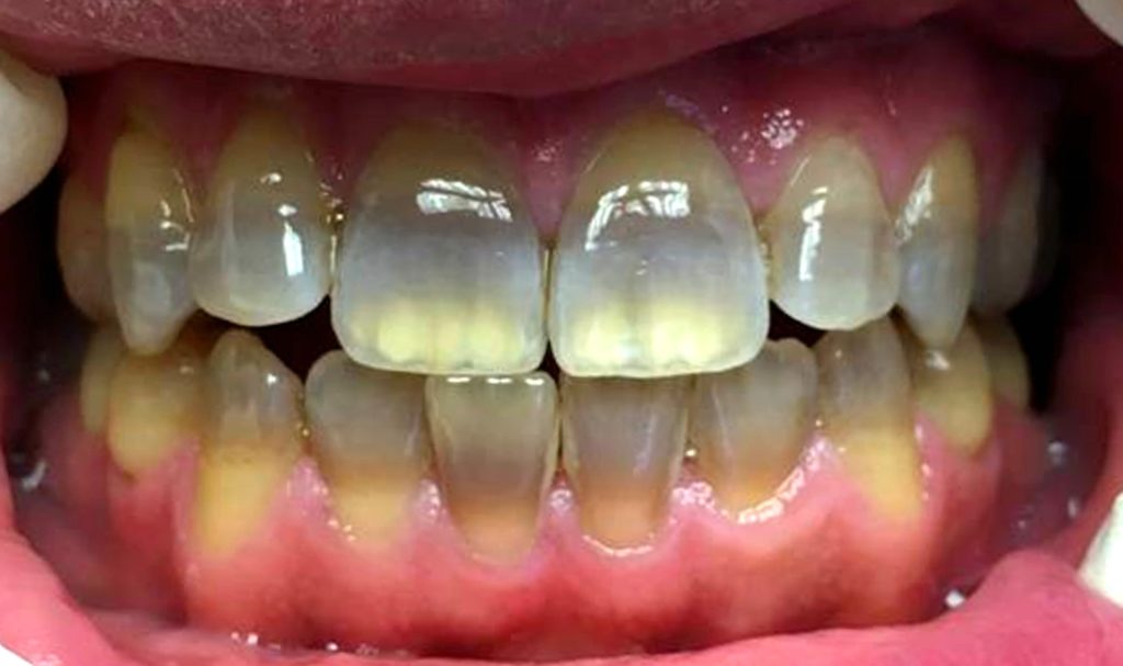 k-r-whitening-helps-one-tetracycline-stained-patient-smile-again
