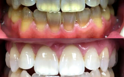 See 100’s Amazing Before and After KöR Whitening Results
