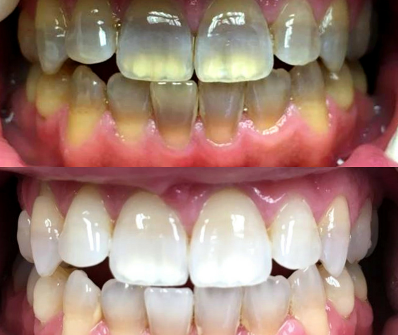 See 100’s Amazing Before and After KöR Whitening Results