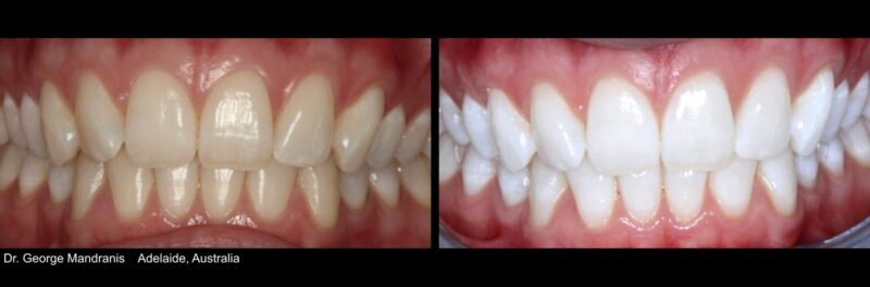 KöR Whitening before and after — coffee and beverage staining